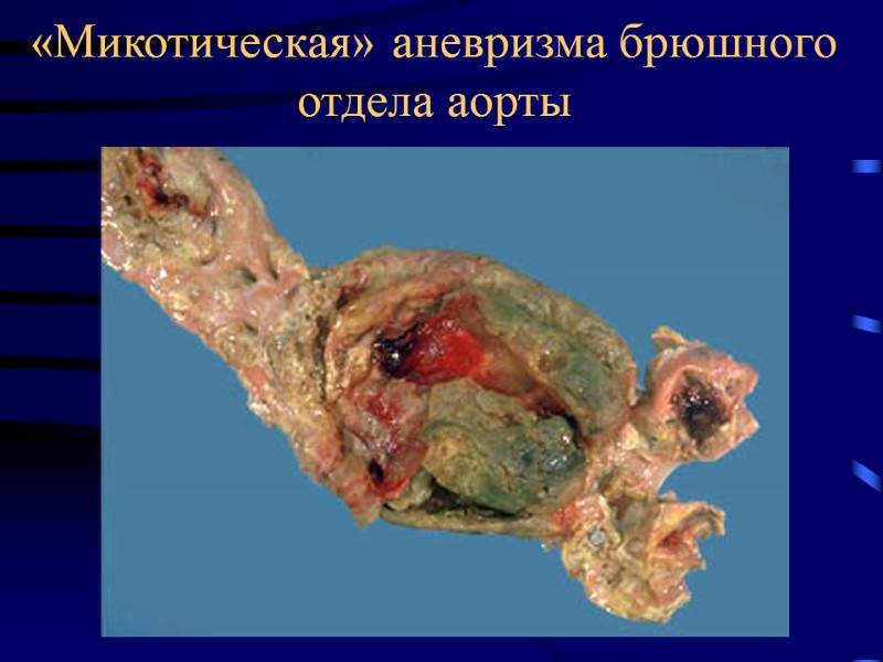 «Микотическая» аневризма брюшного отдела аорты